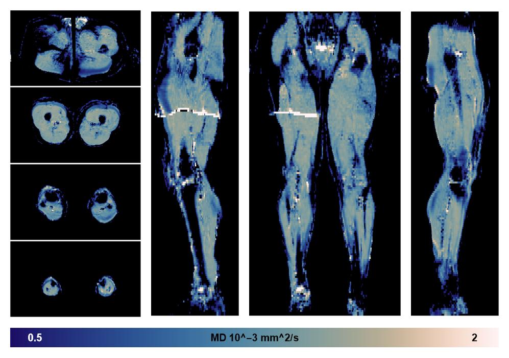 IVIM corrected whole leg muscle mean diffusivity obtained from diffusion tensor imaging.